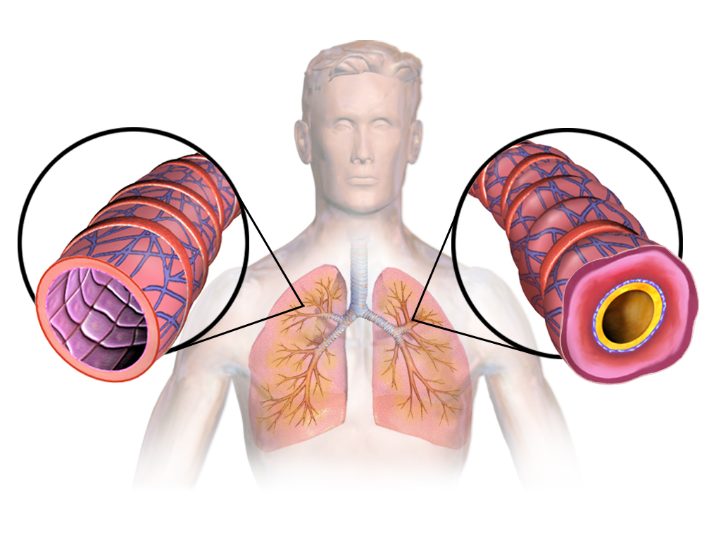 Figure 1. Asthma’s exaggerated contraction of airways is due to a lack of smooth muscle relaxant.