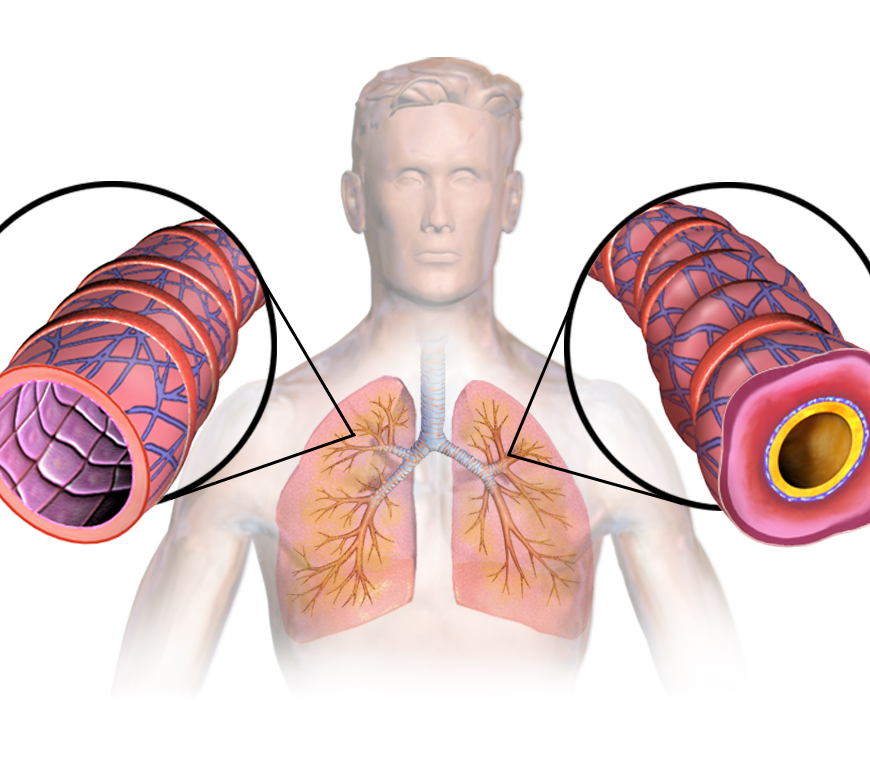 Figure 1. Asthma’s exaggerated contraction of airways is due to a lack of smooth muscle relaxant.