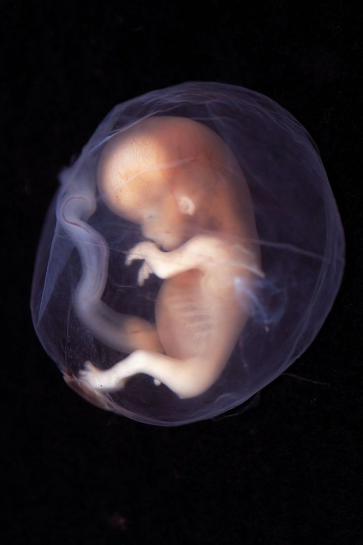 Figure 1: Fetus at 9-10 weeks estimated gestational age (EGA)