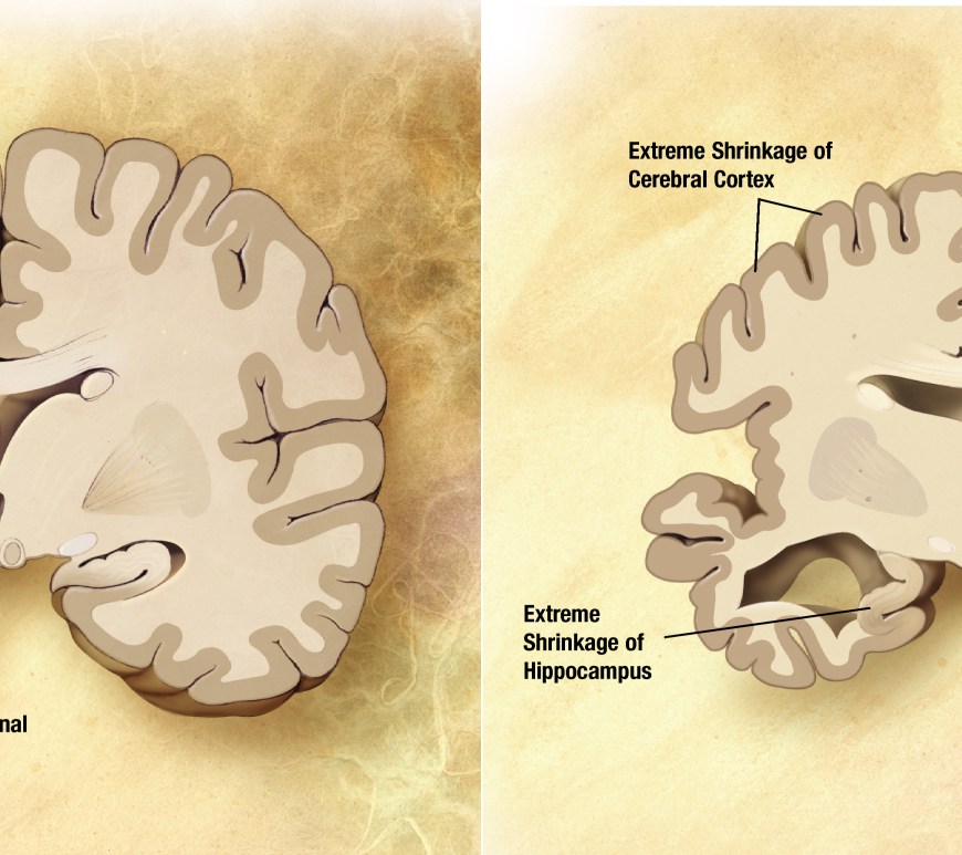 Figure 3. Slow wave activity and low quality sleep affect levels of amyloid beta and tau levels respectively which are linked to Alzheimer’s.