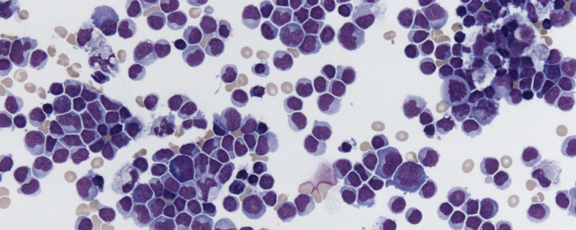 Figure 1. Pleocytosis (shown here) is an increased cell count — particularly an increase in white blood cell (WBC) count — in a bodily fluid such as cerebrospinal fluid (CSF).