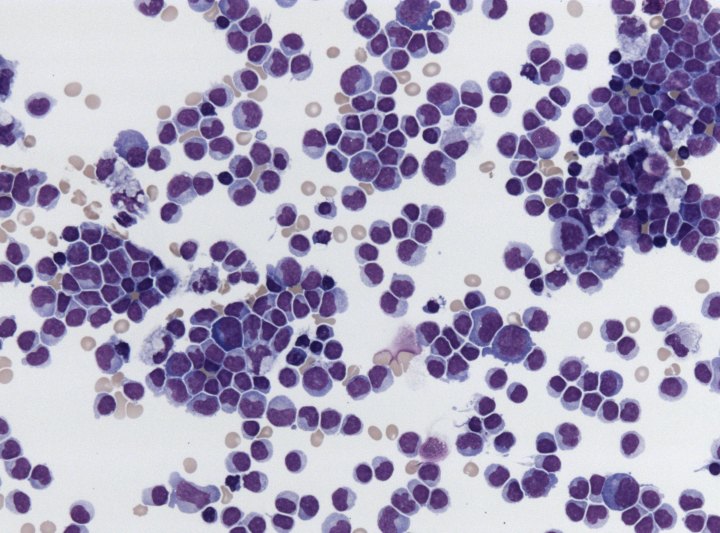 Figure 1. Pleocytosis (shown here) is an increased cell count — particularly an increase in white blood cell (WBC) count — in a bodily fluid such as cerebrospinal fluid (CSF).