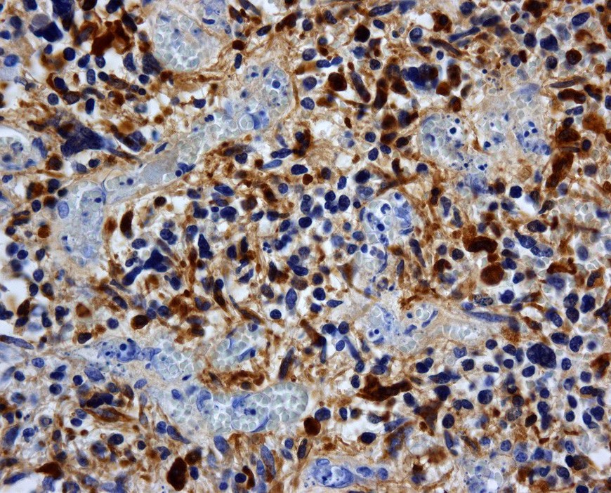 Caption: Glioblastoma cells stained for GFAP proteins.