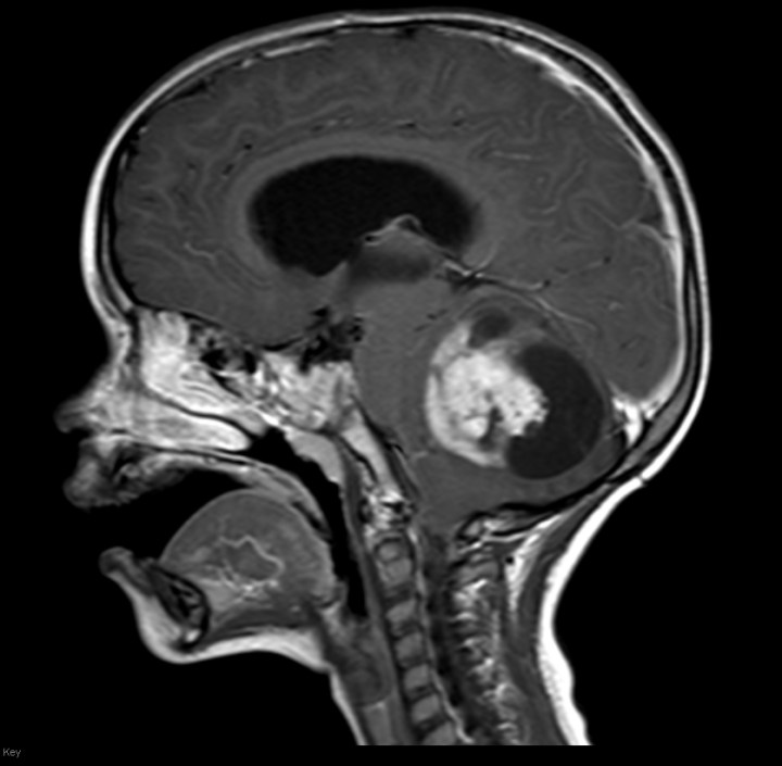 Astrocytoma (1).jpg