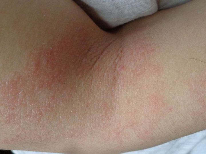 atopicdermatitis.jpg