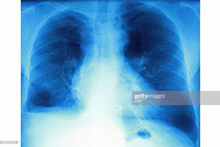 LungFibrosis